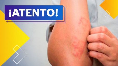 ¿Psoriasis? Te contamos sobre la enfermedad que ataca la piel 